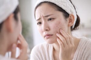 ニキビ跡が気になる女性