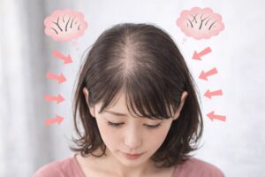 びまん性脱毛症に悩む女性