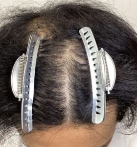 アフター:頭頂部(フォーカス)