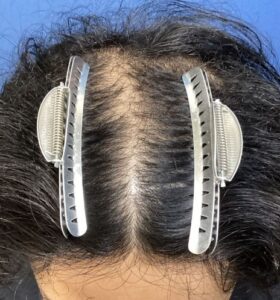 ビフォー:頭頂部(フォーカス)