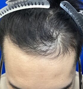 アフター:前頭部