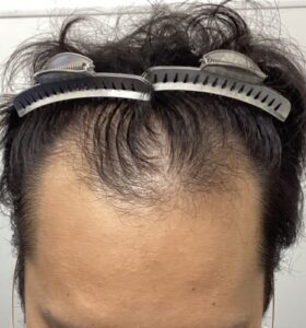 ビフォー:前頭部