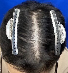 アフター：頭頂部