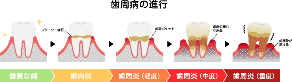 歯周病の進行