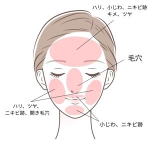 ブレッシングの対象部位