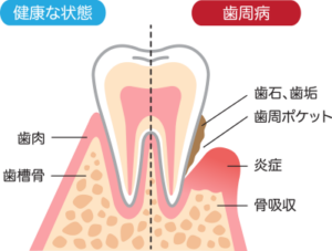 健康な歯と歯周病