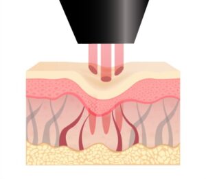 従来のニードル治療