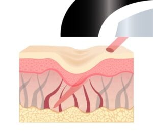 ブレッシングのニードル