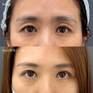 30代女性の二重埋没法(アポロンアイズ法)のビフォーアフター