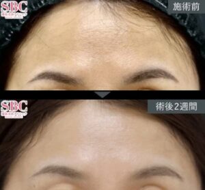 女優注射の30代女性の術前と2週間後の写真