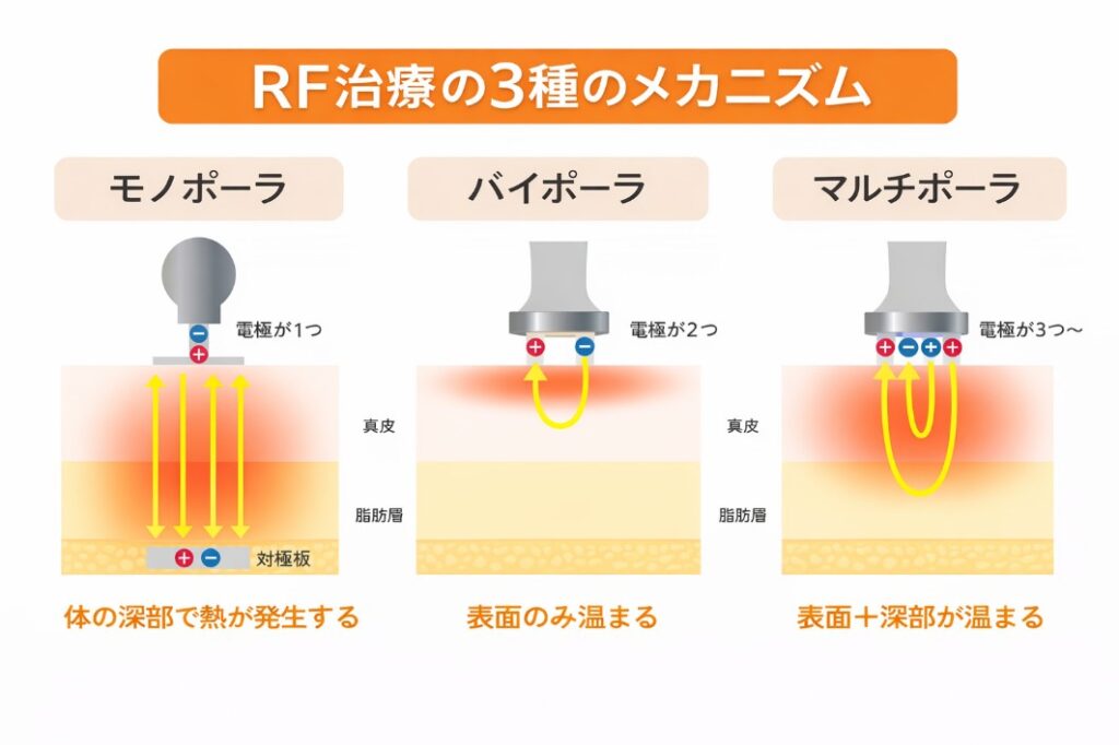 高周波(RF:ラジオ波)の3種のメカニズム