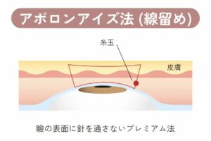 アポロンアイズ法のイラスト