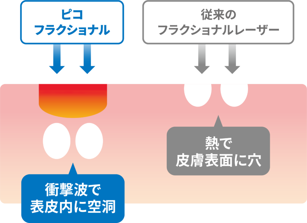 フラクショナルレーザーとピコフラクショナルのメカニズムの違い