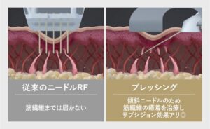 従来のニードルとブレッシングのRF到達範囲の違い