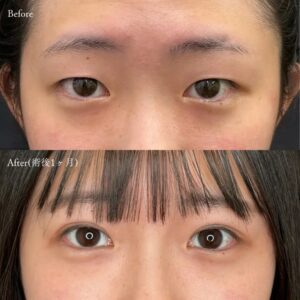 10代女性の二重埋没法(アポロンアイズ法)のビフォーアフター