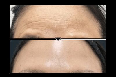 SBCの女優注射の効果（ビフォーアフター）の写真