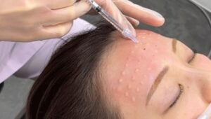 女優注射の施術の様子