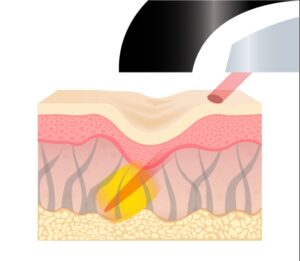 ブレッシングの治療の範囲