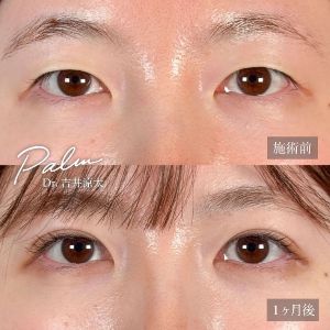 20代女性No.1　二重埋没法ビフォーアフター