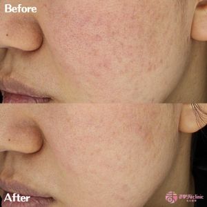 肌の赤み・ハリ改善症例