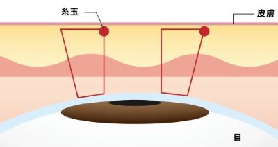 パルムクイック（2点留め）のイラスト