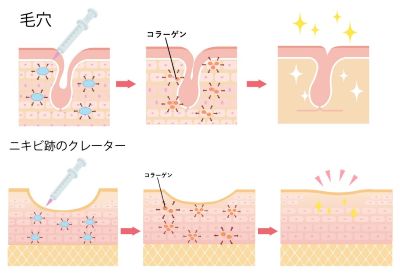 ジュベルックの毛穴やクレーターへの効果発現メカニズム