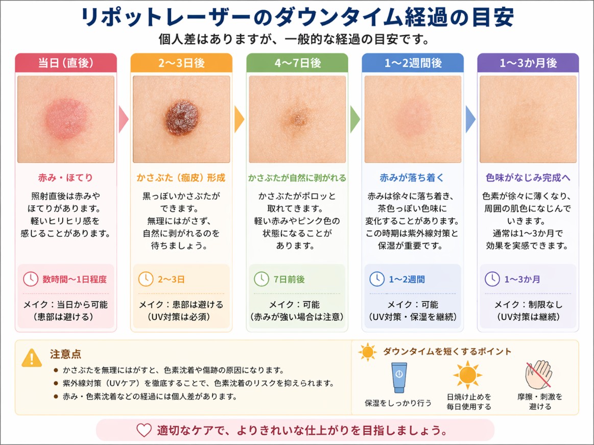 リポットレーザーのダウンタイムの経過