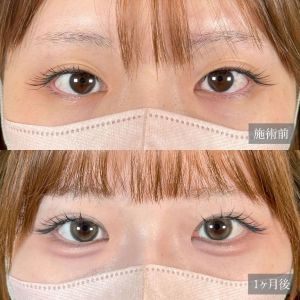 20代女性No.2　二重埋没法ビフォーアフター