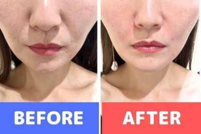 ヒアルロン酸の症例：ビフォーアフターの写真