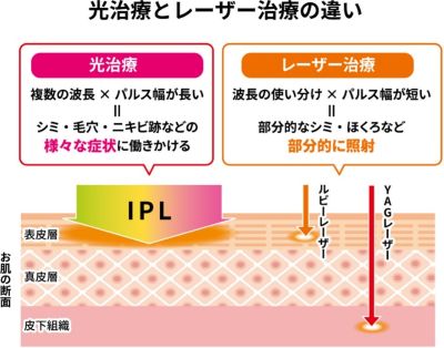  IPLとレーザーのメカニズムの違い