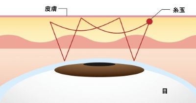 パルムクイック（線留め）のイラスト