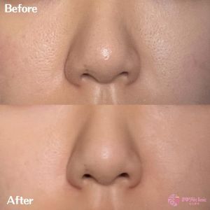 ジュベルックの毛穴や肌全体の質感改善の症例