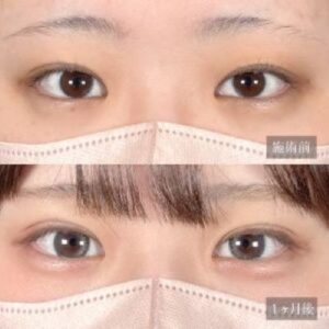 20代女性No.3　二重埋没法ビフォーアフター