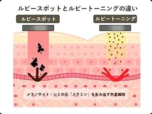 ルビートーニングとルビースポットの違い