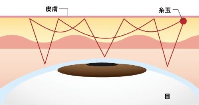 パルムラインプレミアム（自然癒着法）のイラスト