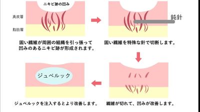 ジュベルックとサブシジョンとの併用効果