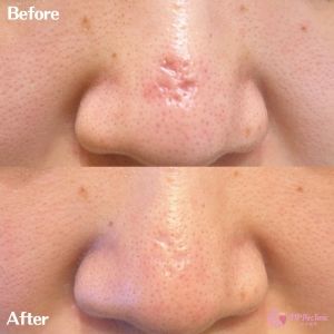 鼻のクレーター改善症例