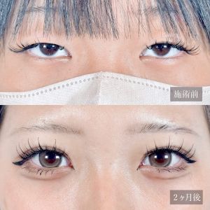 10代女性No.1　二重埋没法ビフォーアフター