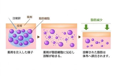 脂肪溶解注射のメカニズム
