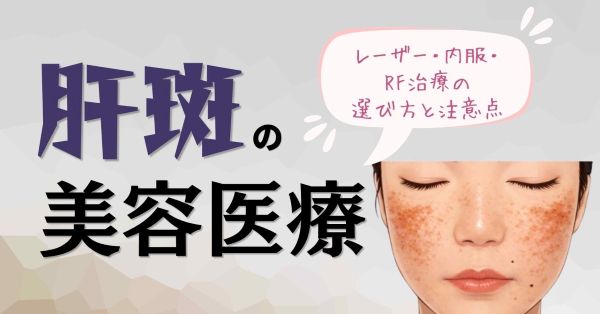 肝斑の美容医療｜レーザー・内服・RF治療の選び方と注意点のアイキャッチ