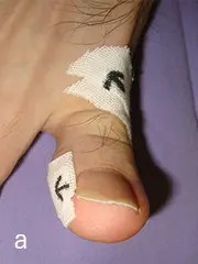 テーピング法