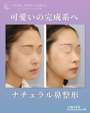 症例１のビフォーアフター（左斜め）