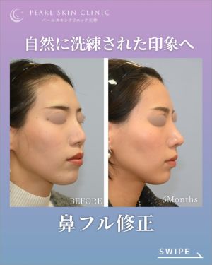 症例3のビフォーアフター（右斜め）