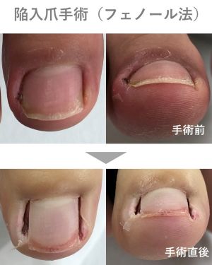 フェノール法の手術前・術後