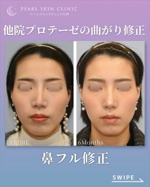 症例3のビフォーアフター（正面）