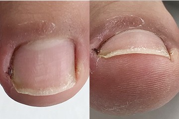 10歳の男子の手術治療の症例