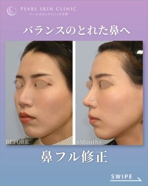 症例3のビフォーアフター（左斜め）