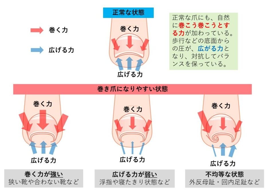 正常な爪と巻き爪になりやすい状態