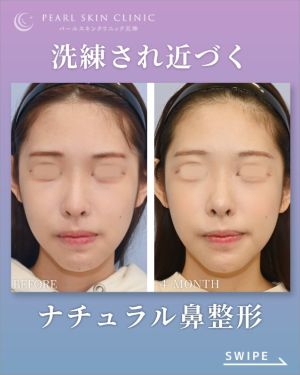 症例１のビフォーアフター（正面）