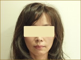 Cプランの施術後（アフター）